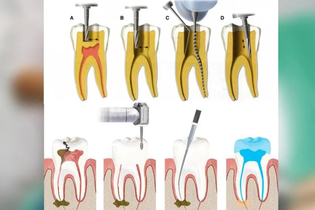 علاج سحب العصب و التهابات جذور السن root canal therapy Kanal Tedavisi