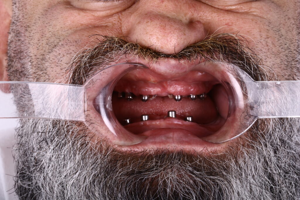İstanbul’da implant cerrahisi sonrası bakım – Diş sağlığı ve iyileşme süreci 2025