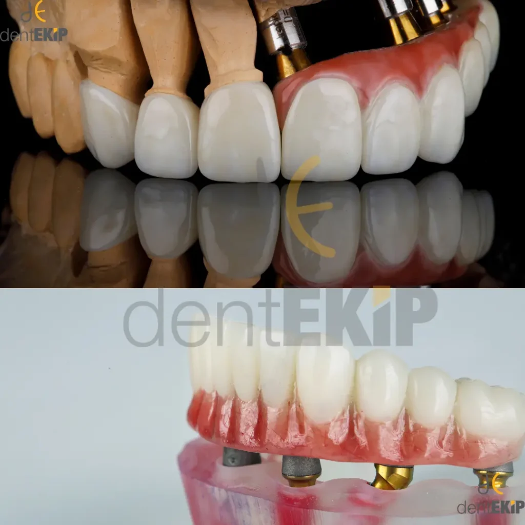 Tools for effective Full Mouth Implants Aftercare Turkey