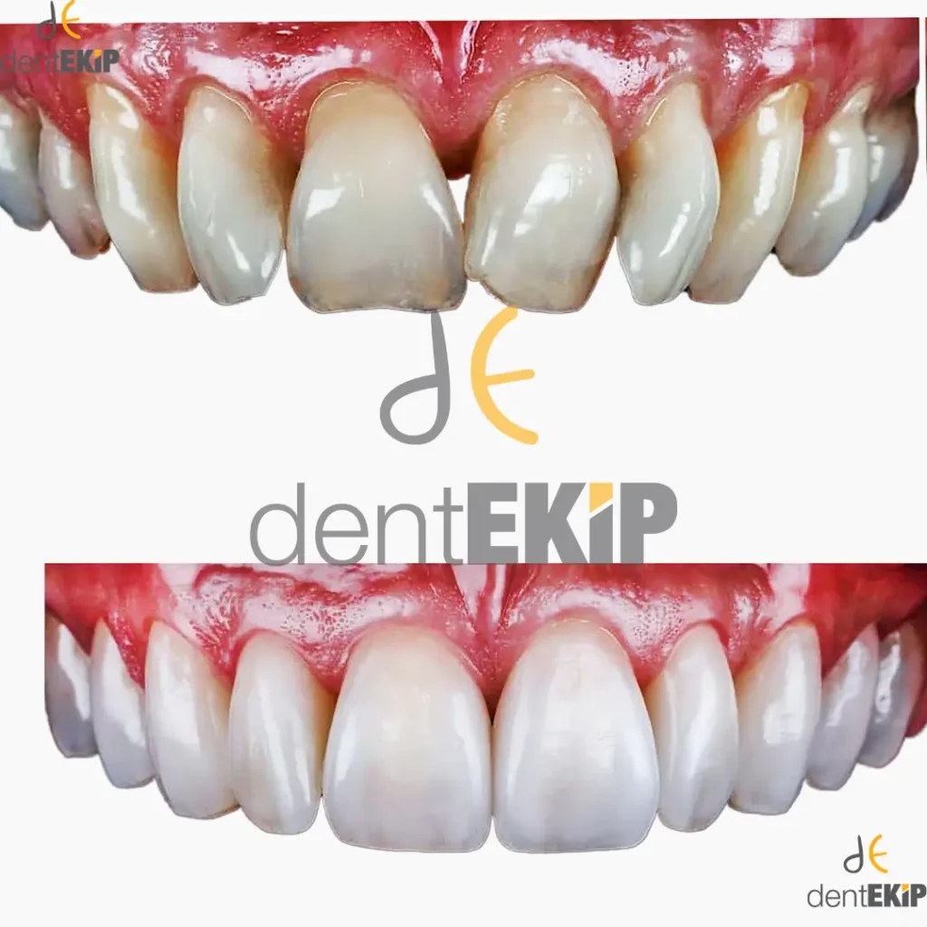 تاج إيماكس يقدم حلًا لمن يتساءل عن الزركونيوم أم الإيماكس
