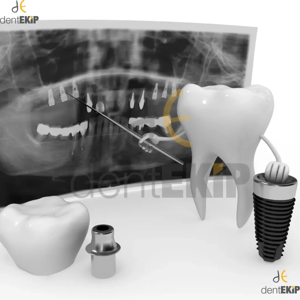 Dental Implants in Turkey
