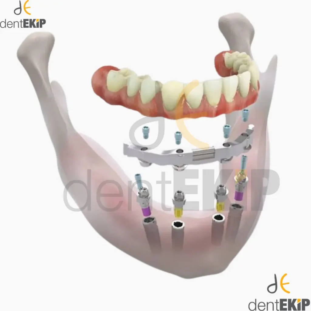 implant sonrası