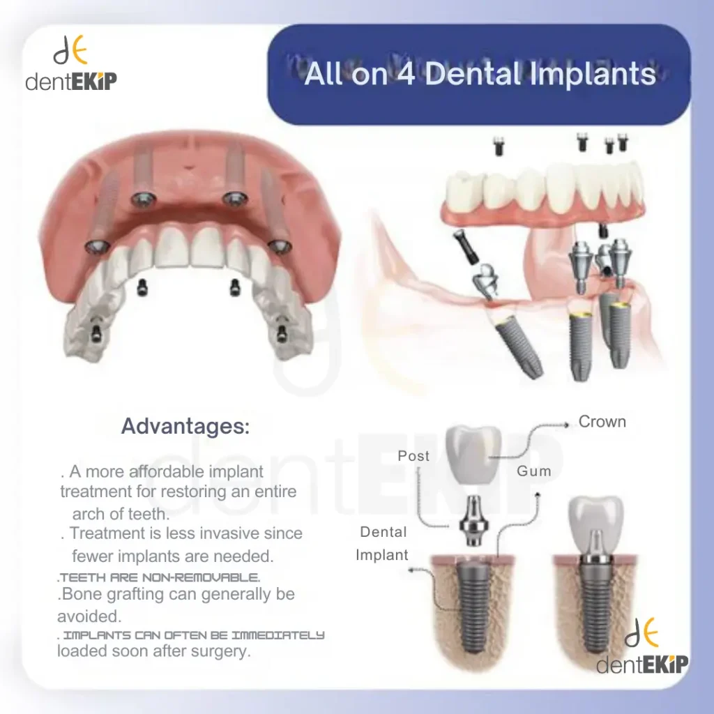 3D dental tomografi üzerinde implant planlaması